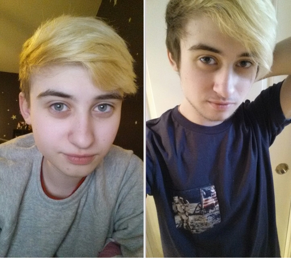 PreT Vs 1 Year On T Ftm