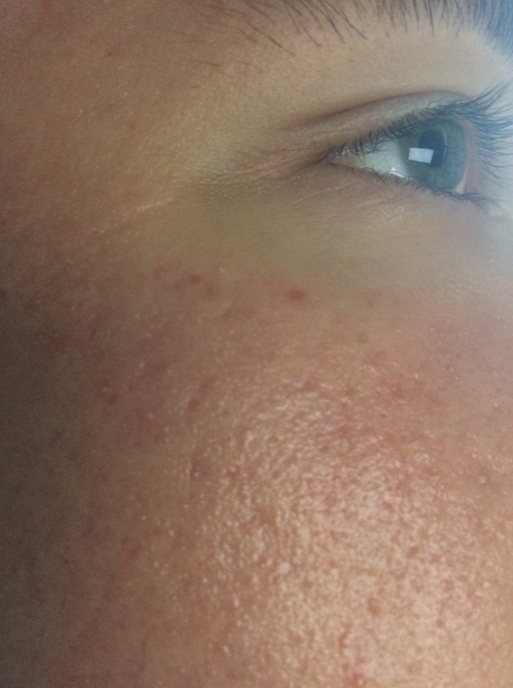 [Skin Concerns] My face feels tight and is red with very tiny little ...