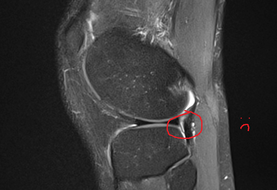 Mrt Bilder Gesundes Knie Links