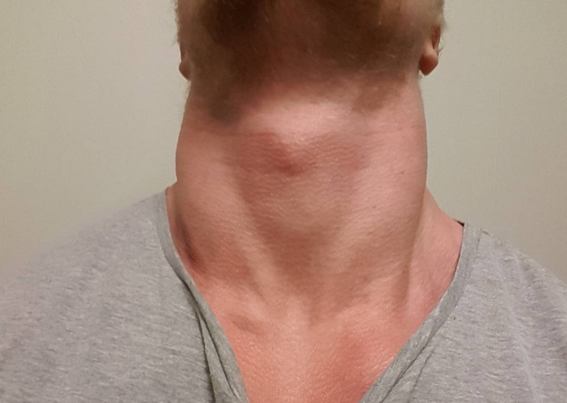 SRS of only 24 days of neck training
