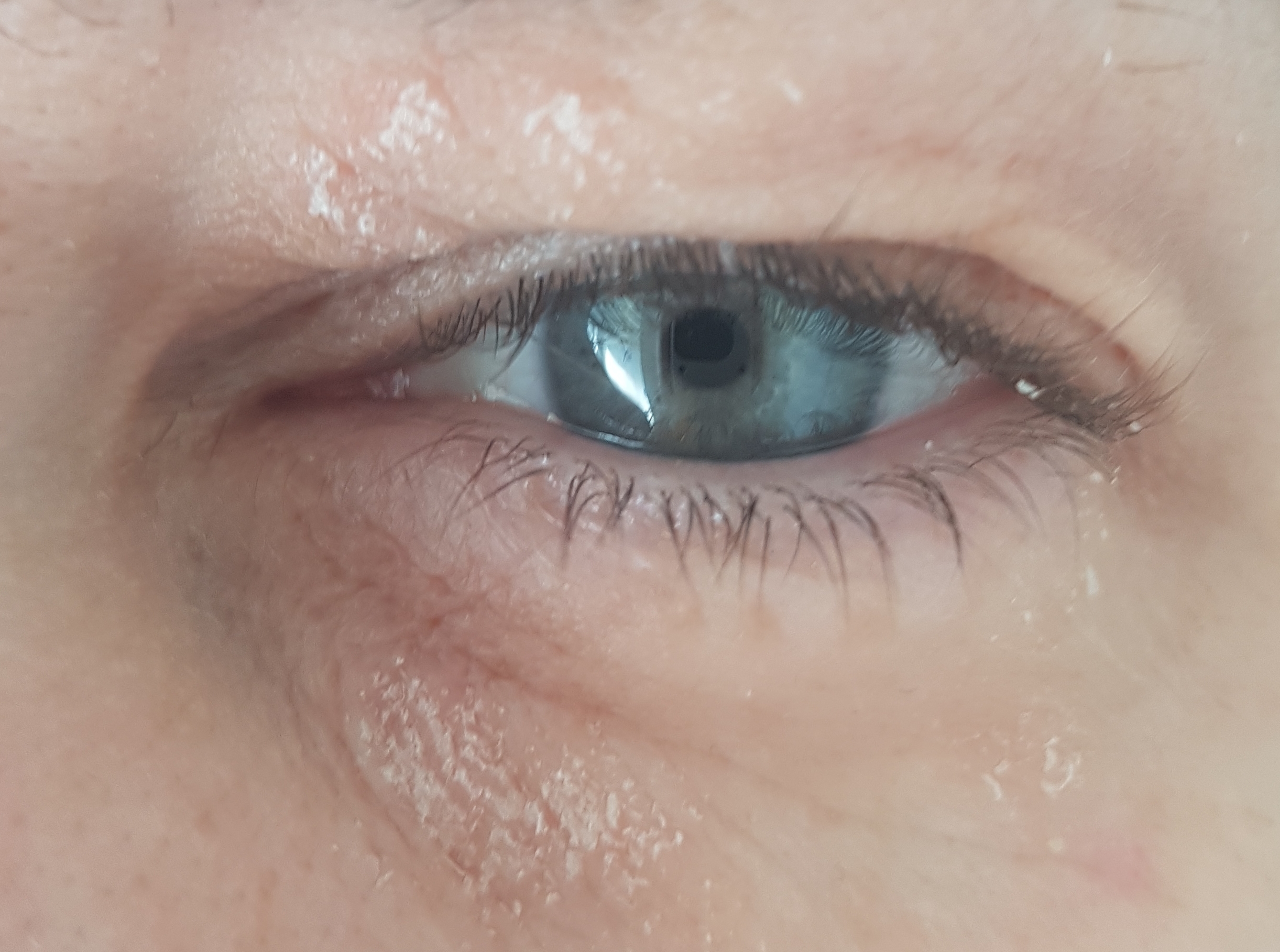 dry-itchy-skin-around-eyes-any-ideas-dermatologyquestions