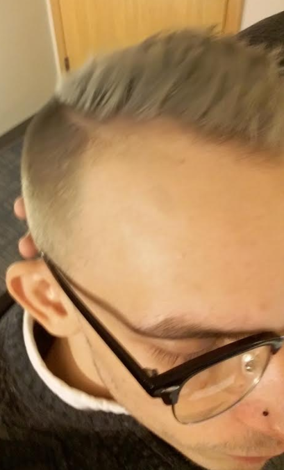 finasteride 1 year no results reddit