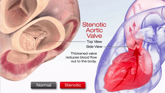 aortic stenosis valve