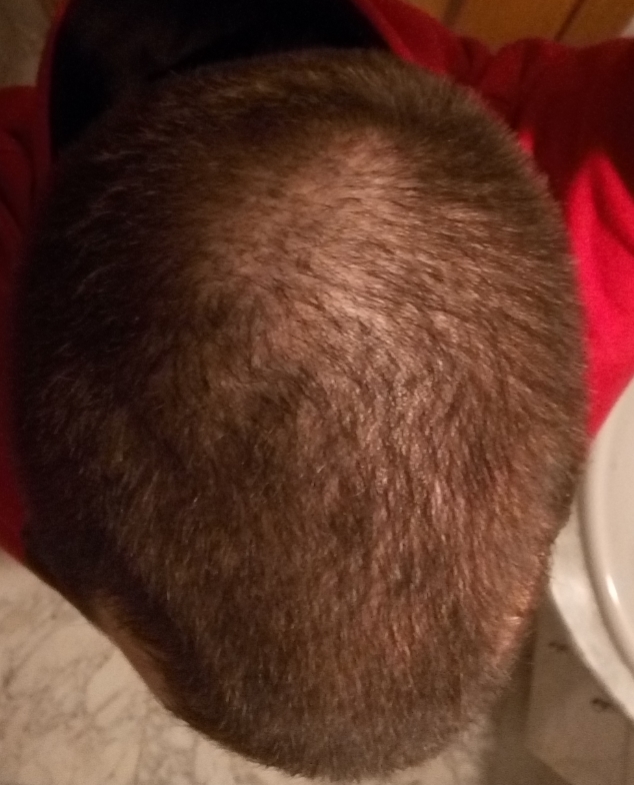 Is it normal to see that much scalp? r/bald