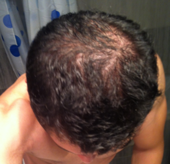 Finasteride achat internet